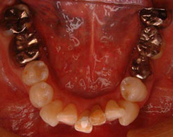 オールセラミック術前