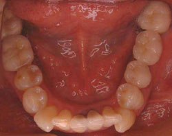 オールセラミック術後