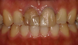 メタルセラミック術前