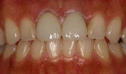 メタルセラミック術後