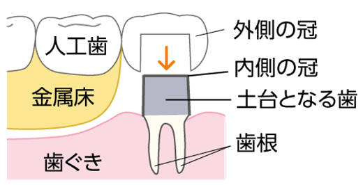 コーヌスクローネ