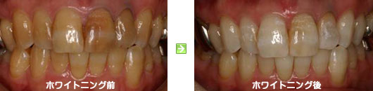 ホワイトニング前後